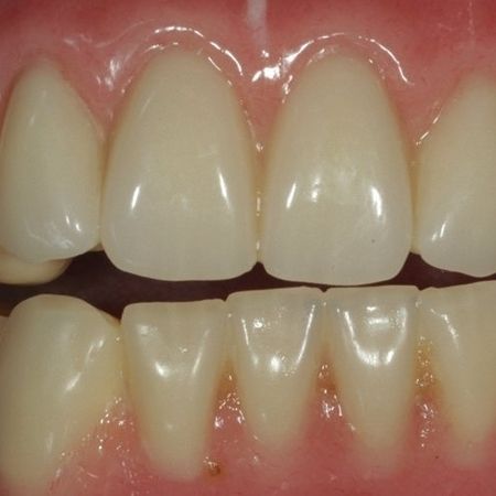 Abb. 28: Die Oberkieferversorgung im Patientenmund: Prüfung der Funktion, Ästhetik und Phonetik. Ein harmonisches Ergebnis, stimmig auch zum Unterkiefer.