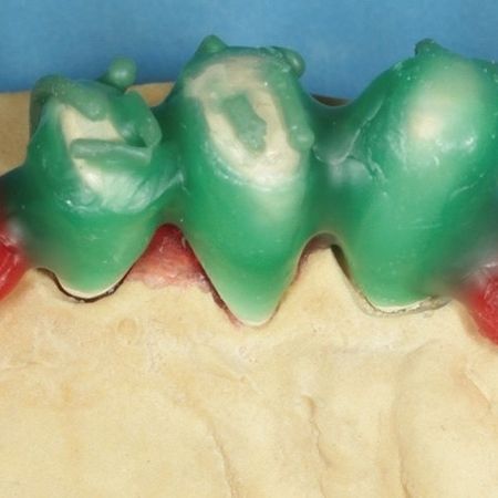 Abb. 14: Das fertig modellierte Sekundärgerüst mit Kronen von lingual.