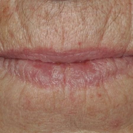 Abb. 9: Das neue Lippenbild gefällt der Patientin besser als das alte, es wirkt natürlicher.