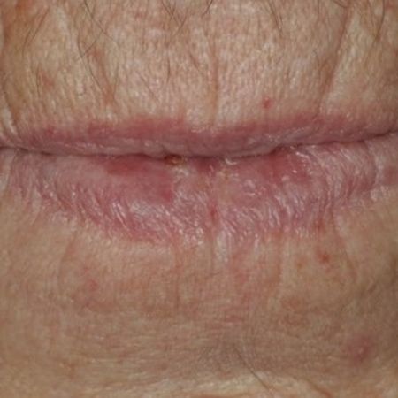 Abb. 2: Die prominente Altversorgung erzeugt aufgeworfene Lippen (vgl. mit der Neuversorgung in Abb. 30).