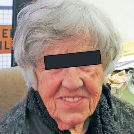 Abb. 1: Patientin mit alter Versorgung. Sie wagt nicht, den Mund weiter als auf dem Bild zu öffnen.