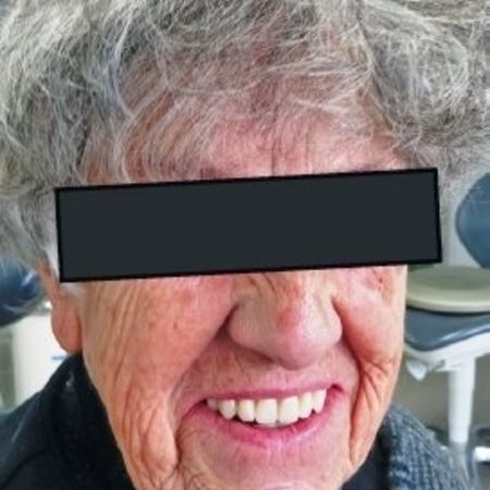 Abb. 33: Mit ihrer neuen natürlich anmutenden Versorgung ist die Patientin hochzufrieden.
