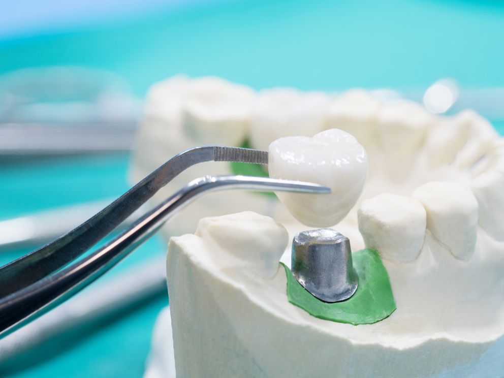 Individuell angepasste Krone